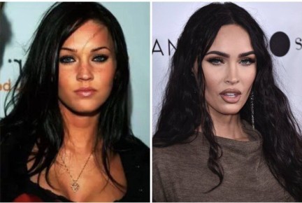 Пластическая хирургия: как звезды преображаются с возрастом