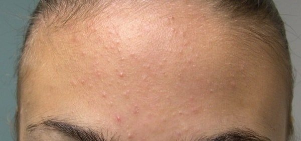 Как справиться с угревыми высыпаниями у подростков: советы и рекомендации